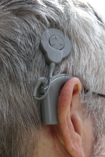 hearing loss Cochlear Implant